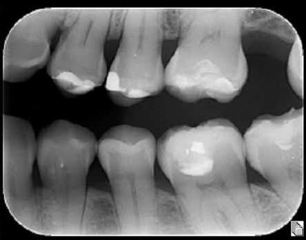 Radiografía coronal/interproximal: