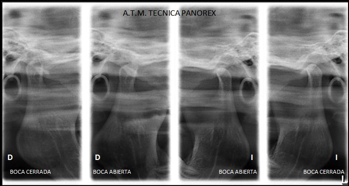 Articulación temporomandibular técnica panorex: