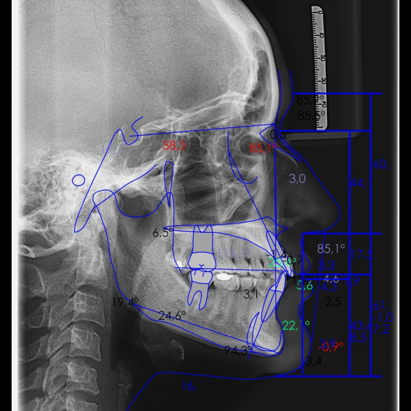 ANALISIS DE ESTUDIO (CEFALOMETRIAS):