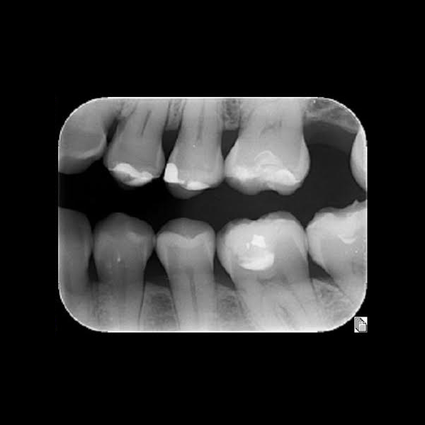 Radiografía coronal/interproximal: