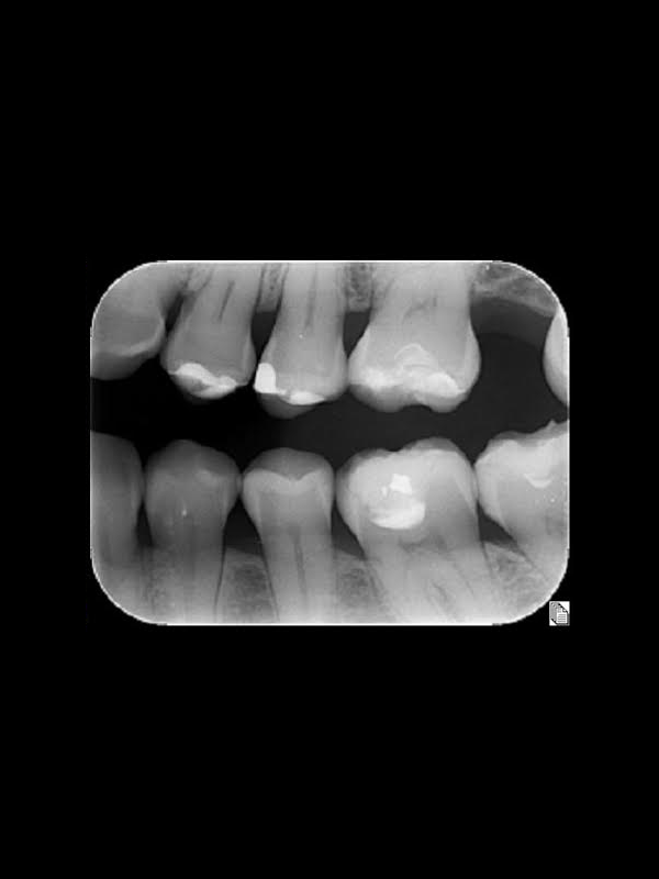 Radiografía coronal/interproximal: