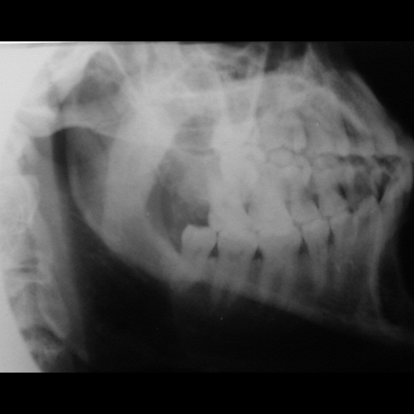 Cuerpo y rama mandibular: