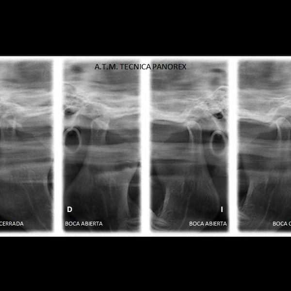 Articulación temporomandibular técnica panorex: