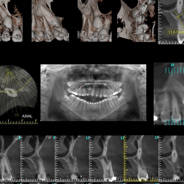 Tomografia Dental